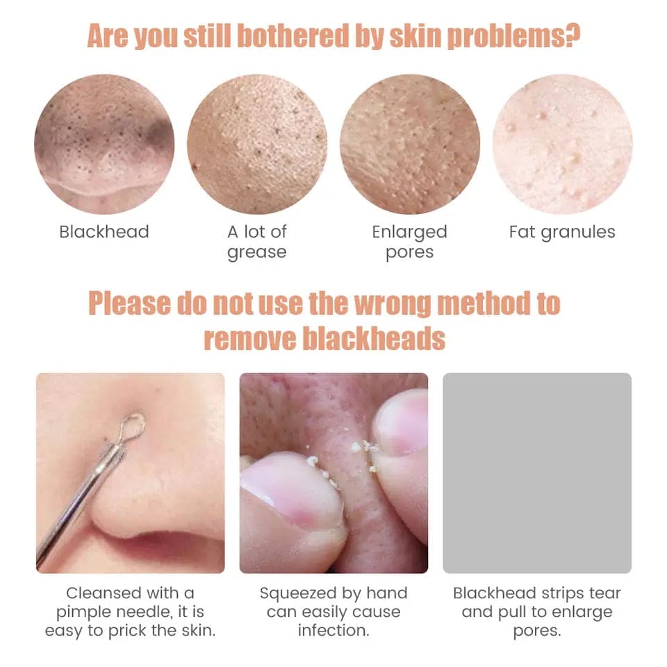 blackhead vacuum machine, dust remover, dirt remover, Pimple Popper Tool Pore Vacuum Black Head Remover, Whitehead Acne remover